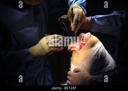 A patient undergoes knee replacement surgery at a West Midlands hospital, after being diagnosed with irreparable damage Stock Photo
