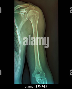 Normal shoulder and elbow joints, X-ray Stock Photo - Alamy