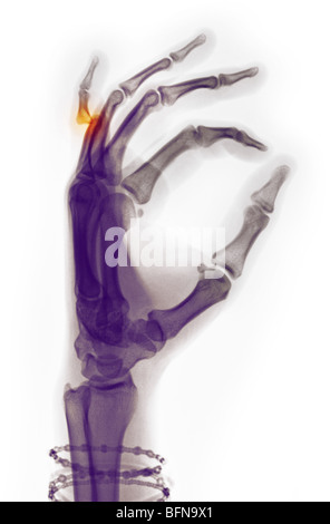 colorized x-ray of a woman's hand showing a dislocation of the 5th finger Stock Photo