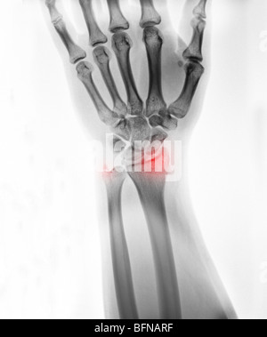 x-ray of the hand and wrist of an 18 year old male showing a fractured wrist at the distal radius and ulnar styloid Stock Photo