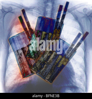 cigarettes, the primary cause of lung cancer, superimposed over a chest x-ray showing lung cancer Stock Photo