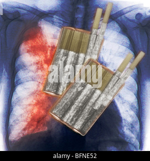 cigarettes, the primary cause of lung cancer, superimposed over a chest x-ray showing lung cancer Stock Photo