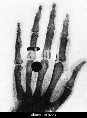 1895 - Wilhelm Conrad Rontgen Discovered The X-rays On November 8 Stock ...