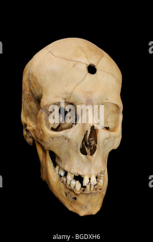 Bullet hole with radiating fractures in human cranium Stock Photo