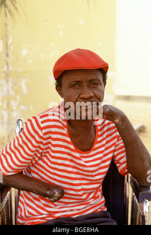 A resident in a leper colony, Luanda, Angola.  He has lost most of his fingers. Stock Photo