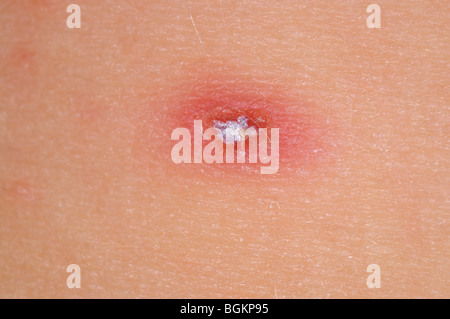 close up photograph of chicken pox vesicles on a young girl Stock Photo