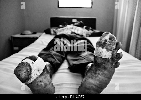 A leprous man waiting for an ambulatory treatment in the Hopital Cardinal Leger in Leogane, Haiti. Stock Photo