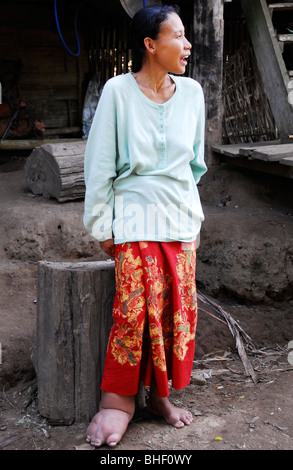 A Karen women suffering from Elephantiasis with  bloated leg , mae la refugee camp , near mae sot , north thailand Stock Photo