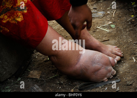 A Karen women suffering from Elephantiasis with  bloated leg, mae la refugee camp , near mae sot , north thailand Stock Photo