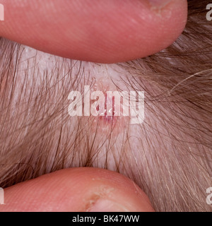 A MODEL RELEASED picture of a six year old boy's chickenpox ( Varicella ) blisters on his head in the Uk Stock Photo
