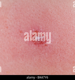 A MODEL RELEASED picture of a six year old boy's chickenpox ( Varicella ) blisters in the Uk Stock Photo