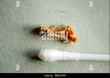 Large piece of Ear wax removed from child with blocked hearing Stock Photo