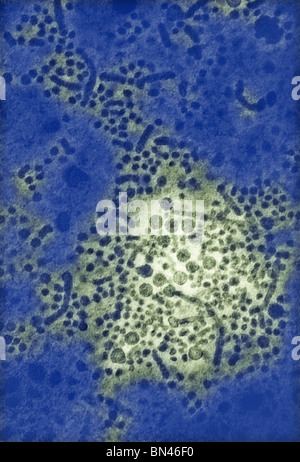 Colorized negatively-stained transmission electron micrograph (TEM) of hepatitis B virus (HBV) virions