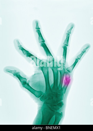 hand x-ray of a 57 year old man showing a 5th metacarpal (boxer's ...