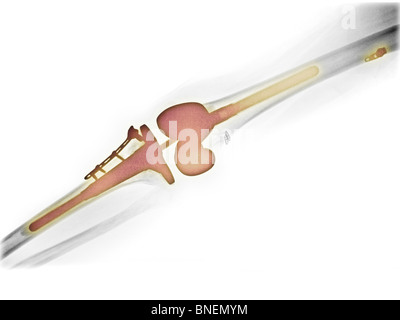 x-ray of the leg showing a total knee replacement Stock Photo