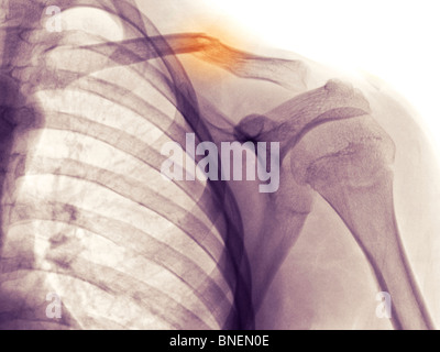 shoulder x-ray showing fractured clavicle Stock Photo