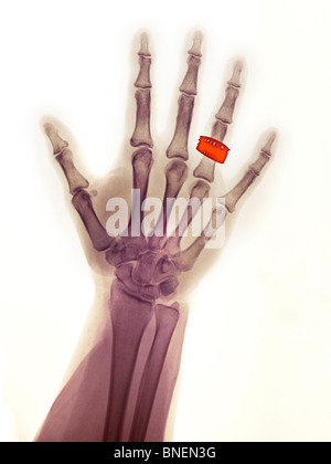hand x-ray of woman wearing a wedding ring Stock Photo