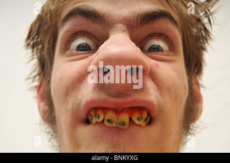 Hideous Monstrous Man staring at the camera with wide eyes, yellow crooked teeth with braces and huge nose. Eww! Ugly. Stock Photo