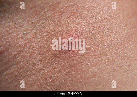 Large acne spot or pimple on a mans neck Stock Photo, Royalty Free ...