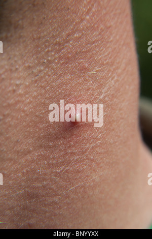 Large acne spot or pimple on a mans neck Stock Photo - Alamy