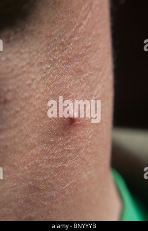 Large acne spot or pimple on a mans neck Stock Photo - Alamy