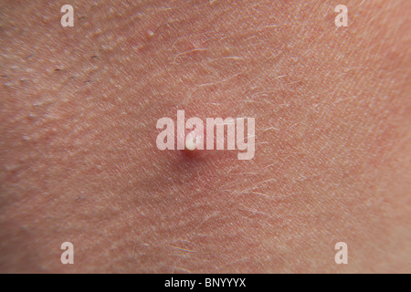 Large acne spot or pimple on a mans neck Stock Photo, Royalty Free ...