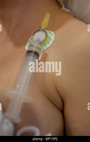 Pregnant woman with an edpidural drip attached during labour Stock Photo