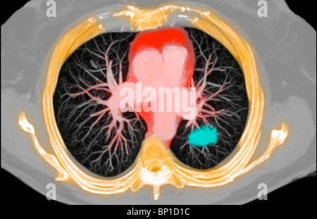 CT scan axial section showing a lung cancer in a 77 year old woman Stock Photo