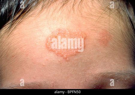 FUNGAL RASH ON THE FOREHEAD Stock Photo