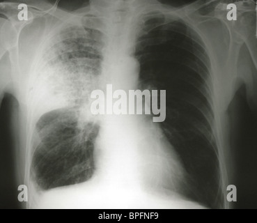 chest x ray Right Upper Lobe Collapse Stock Photo - Alamy