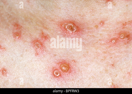 A picture of a highly infectious disease caused by varicella, a