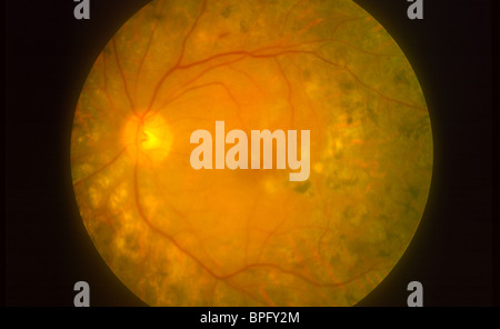 A retinal photograph showing diabetic retinopathy in the macular area showing the macula and optic disc. Stock Photo