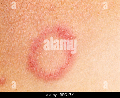 Tinea corporis caused by ringworm. Rash on buttocks Stock Photo - Alamy