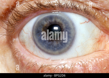 Corneal arcus appears as a whitish ring on the peripheral cornea with a clear zone between it and the limbus. Stock Photo