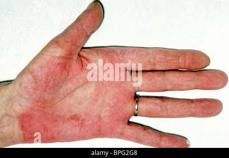 Palmar erythema is a reddening of the palms of the hands. Stock Photo