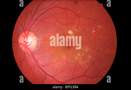 Diabetic maculopathy.  View of the retina of a diabetic patient showing retinal maculopathy. Stock Photo