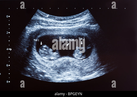 Baby scan twins hi-res stock photography and images - Alamy