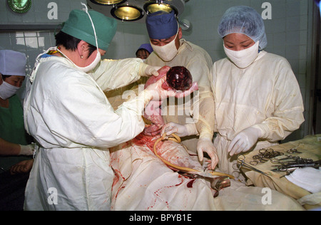 Caesarian section in Mongolia Stock Photo