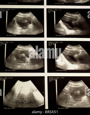 Clinical report on ultrasound of enlarged prostate gland of a Stock ...