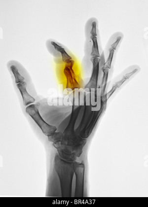 lateral hand x-ray of a 52 year old man who crushed the proximal phalanx of his index finger Stock Photo