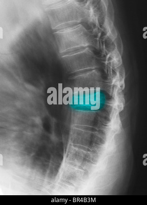 dorsal spine x-ray in lateral view showing a T7 compression fracture in ...