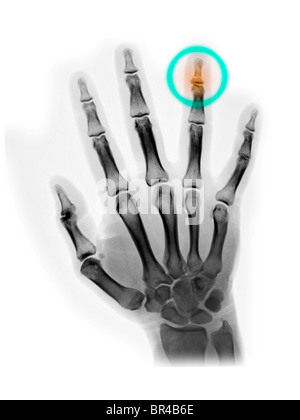 hand x-ray of a 40 year old man who  hit his ring finger with a hammer and broke his distal phalanx (fingertip) Stock Photo