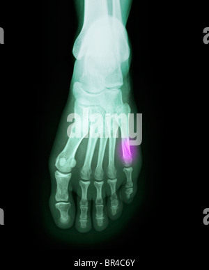 foot x-ray of a 37 year old female with a fractured 5th metatarsal Stock Photo