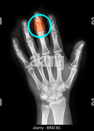 x-ray of the hand of a 40 year old woman showing a fractured middle finger Stock Photo