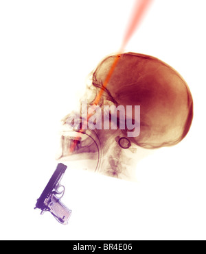 skull x-ray of a 30 year old man who committed suicide by shooting himself in the head. Stock Photo