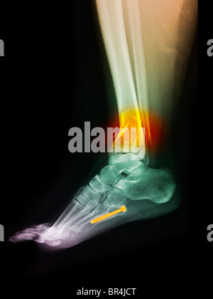 x-ray of the leg of a 43 year old woman who fractured her ankle Stock Photo