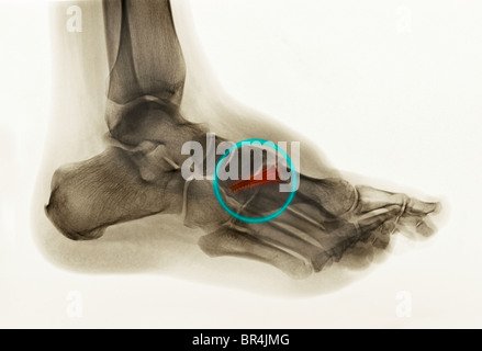 foot x-ray of a 30 year old man who had surgery of the first metatarsal with 2 screws fusing the metatarsal to the tarsal Stock Photo