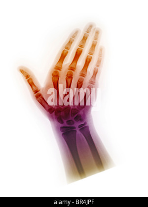 x-ray showing the hand of an 8 year old, normal hand x-ray of an 8 year old girl Stock Photo