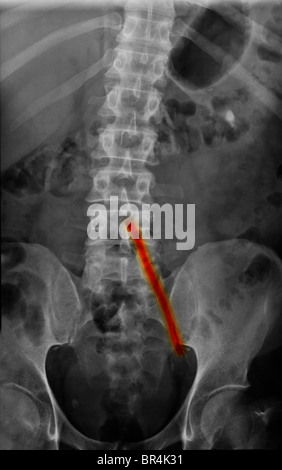 x-ray of a 51 year old man who had an aorto-iliac wire-mesh bypass graft Stock Photo