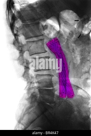 x-ray showing a wiremesh aortoiliac bypass graft Stock Photo - Alamy